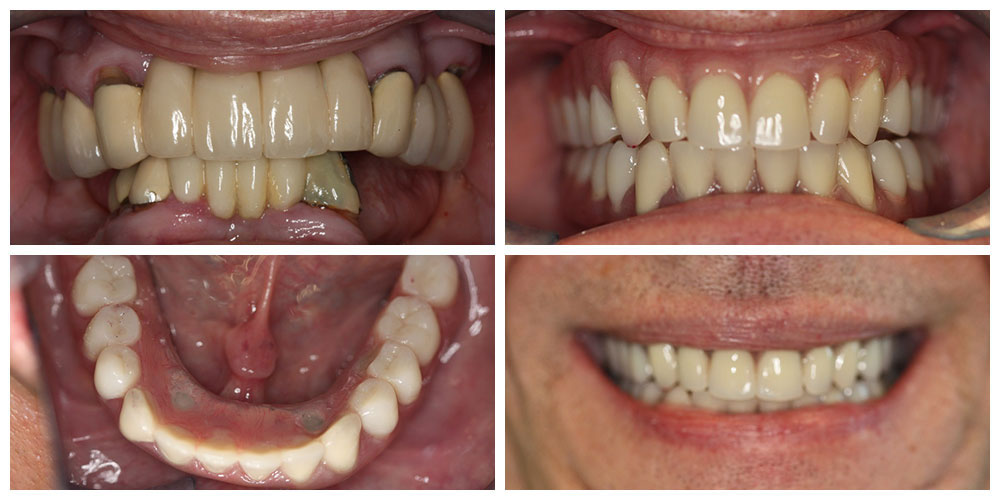 Full Mouth Rehab- Upper Denture & Lower Hybrid Acrylic
