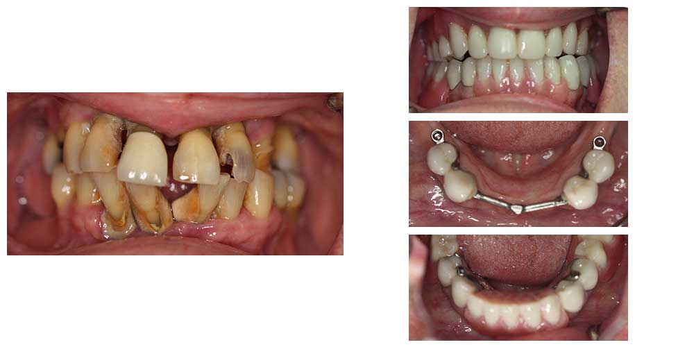 Full Mouth Rehab- Upper Denture, Lower Partial with Crowns & Attachments