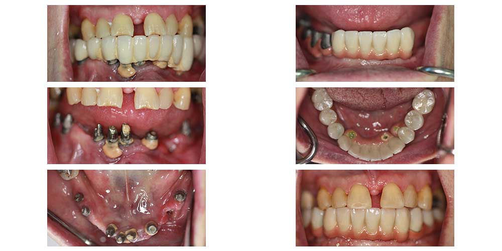 Full Arch Implant Supported Bridge