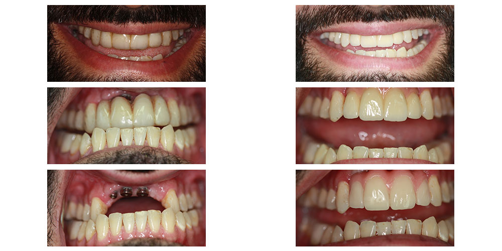 Implant Supported Bridge